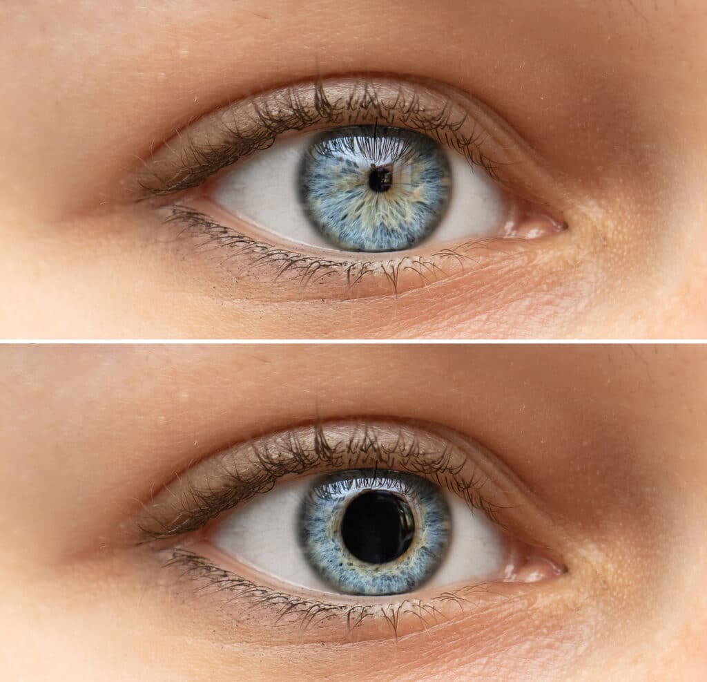 Dilated Pupils